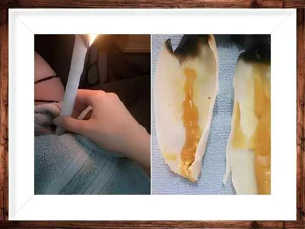 Limpeza de ouvidos com cone chinês 1 - Fabricação e Venda de Cone Chinês e Hindu | São José e Fpolis Limpeza de ouvido profissional com cone chinês, técnica segura e relaxante para higiene auricular